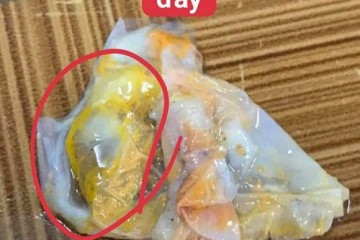Đọc kết quả mảng viêm từ viên đặt phụ khoa Tiêu Viêm Nữ và các loại bệnh phụ khoa