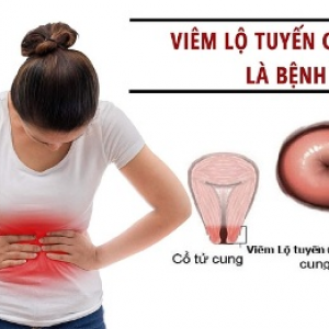 Sản phẩm viên đặt phụ khoa tiêu viêm nữ Hoàng Sơn có chữa được không viêm lộ tuyến cổ tử cung tại nhà không?