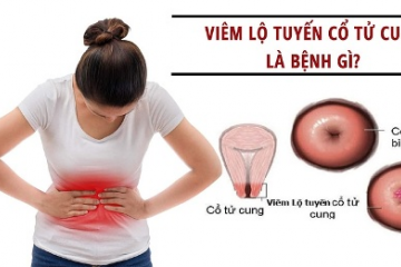 Sản phẩm viên đặt phụ khoa tiêu viêm nữ Hoàng Sơn có chữa được không viêm lộ tuyến cổ tử cung  tại nhà  không? 