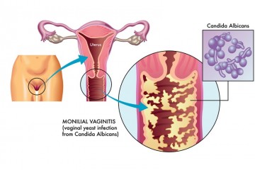 Viên đặt phụ khoa tiêu viêm nữ có chữa được nấm Candida ở âm đạo được không?
