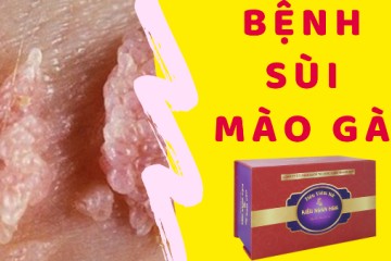 Viên đặt phụ khoa tiêu viêm nữ có cách chữa bệnh sùi mào gà tại nhà có đúng không?
