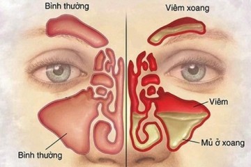 Các Cách Chữa Xoang Tại Nhà - Cùng Tiêu Viêm Nữ