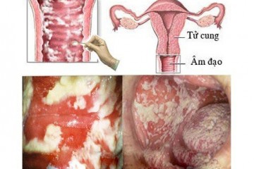 THỐNG KÊ CÁC LOẠI VIÊM ÂM ĐẠO (Viêm phụ khoa) CHỊ EM CẦN CHÚ Ý