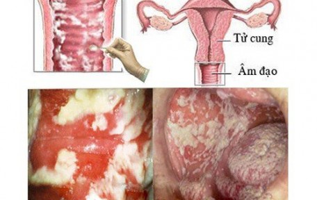 THỐNG KÊ CÁC LOẠI VIÊM ÂM ĐẠO (Viêm phụ khoa) CHỊ EM CẦN CHÚ Ý