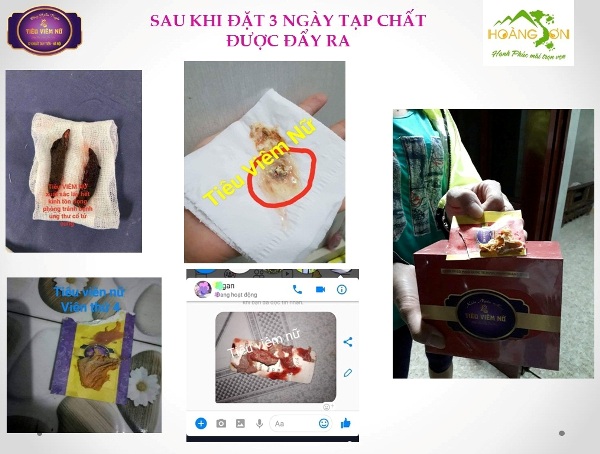 Feedback tiêu viêm nữ