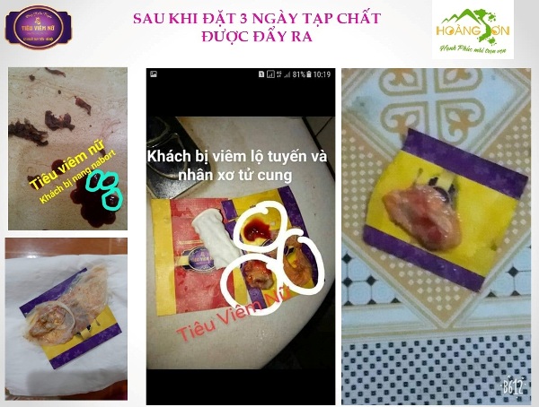 Feedback tiêu viêm nữ